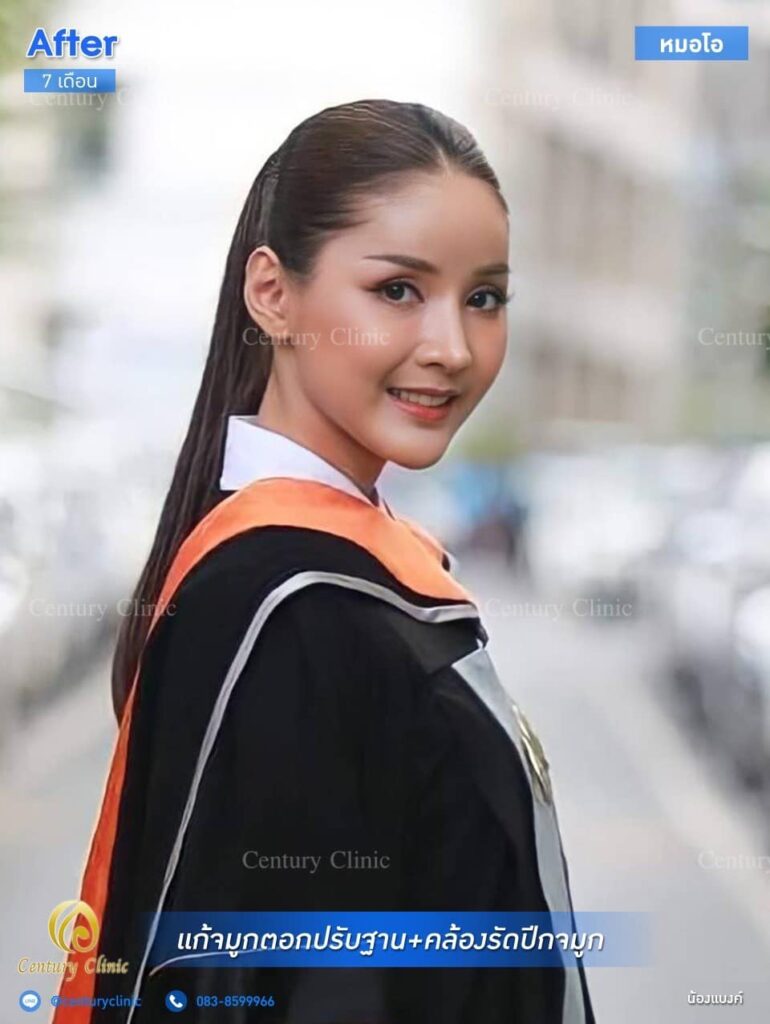 Century รีวิว แก้จมูก 1#168