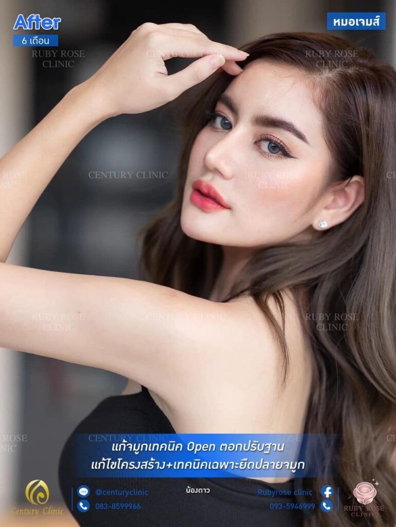 รีวิว แก้จมูก #175 , Century Clinic Thailand Century รีวิว แก้จมูก 1#175