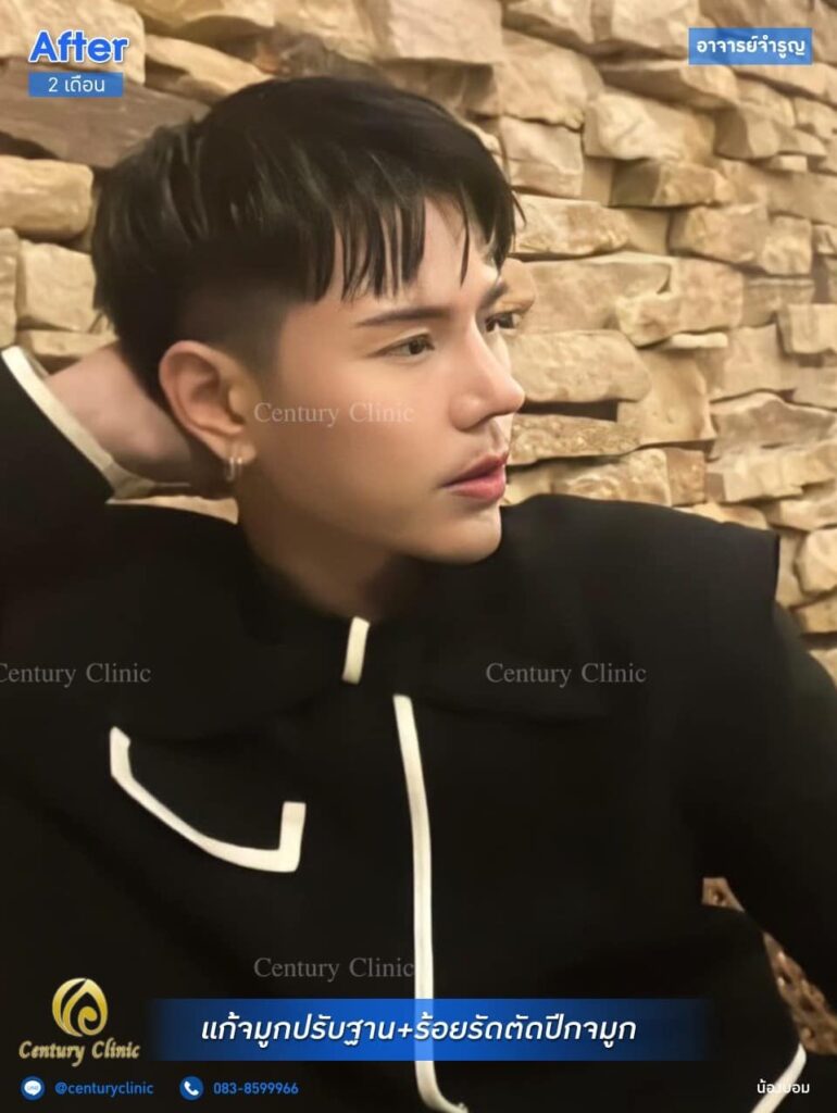 รีวิว แก้จมูก #181 , Century Clinic Thailand Century รีวิว แก้จมูก 1#181