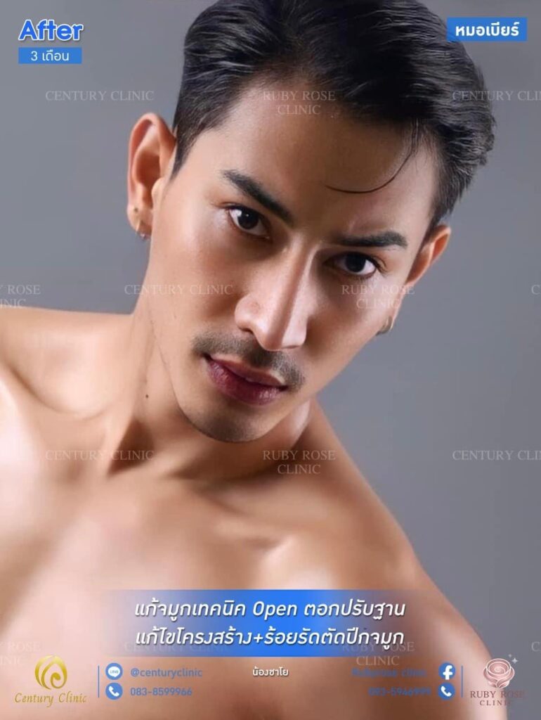 Century รีวิว แก้จมูก 1#182