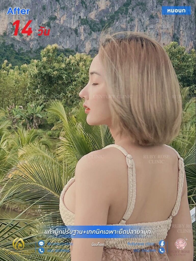Century รีวิว แก้จมูก 1#186