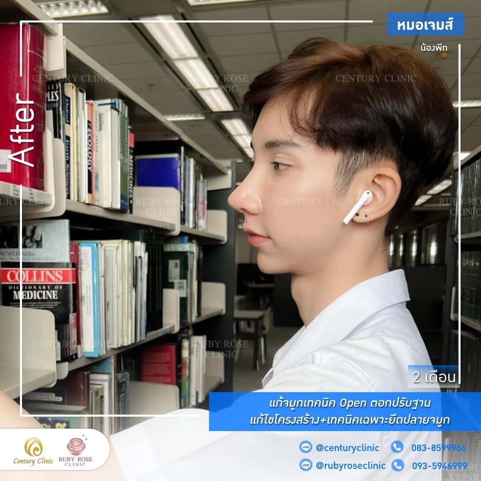 Century รีวิว แก้จมูก 1#192