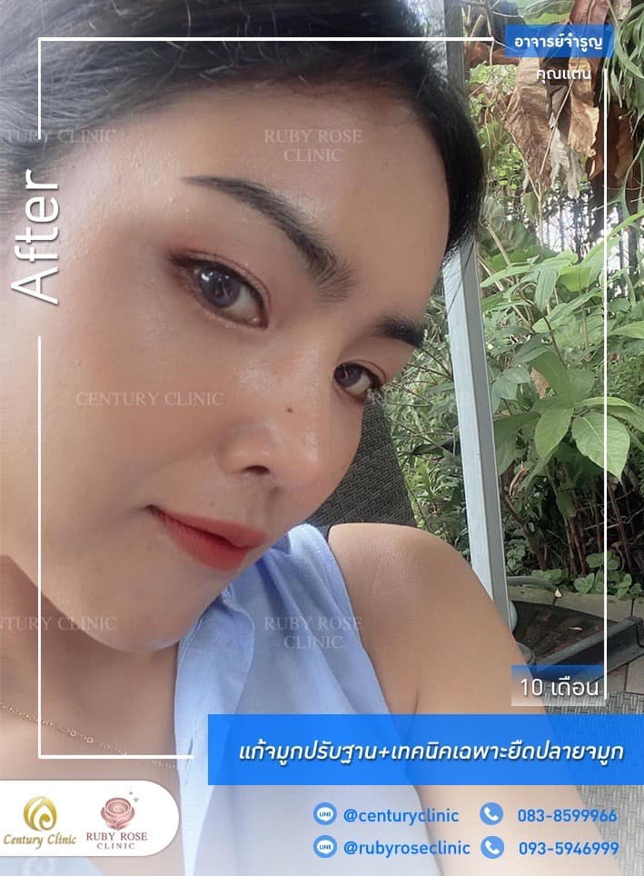 Century รีวิว แก้จมูก 1#196