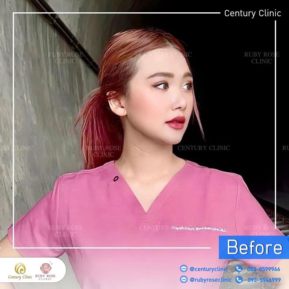 รีวิว แก้จมูก #198 , Century Clinic Thailand Century รีวิว แก้จมูก 1#198