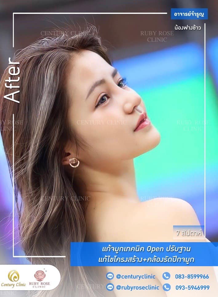 Century รีวิว แก้จมูก 1#200