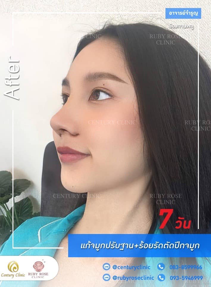 Century รีวิว แก้จมูก 1#204