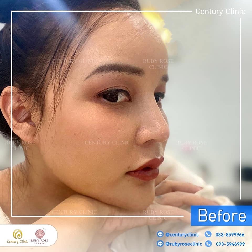 รีวิว แก้จมูก #205 , Century Clinic Thailand Century รีวิว แก้จมูก 1#205