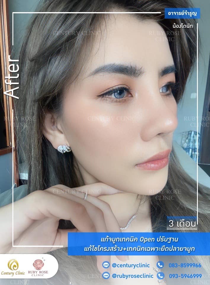 Century รีวิว แก้จมูก 1#206