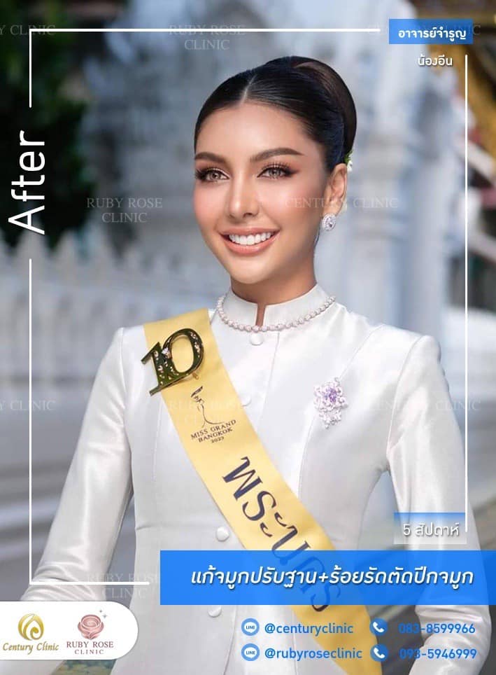 Century รีวิว แก้จมูก 1#211