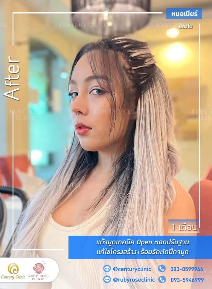รีวิว แก้จมูก #212 , Century Clinic Thailand Century รีวิว แก้จมูก 1#212