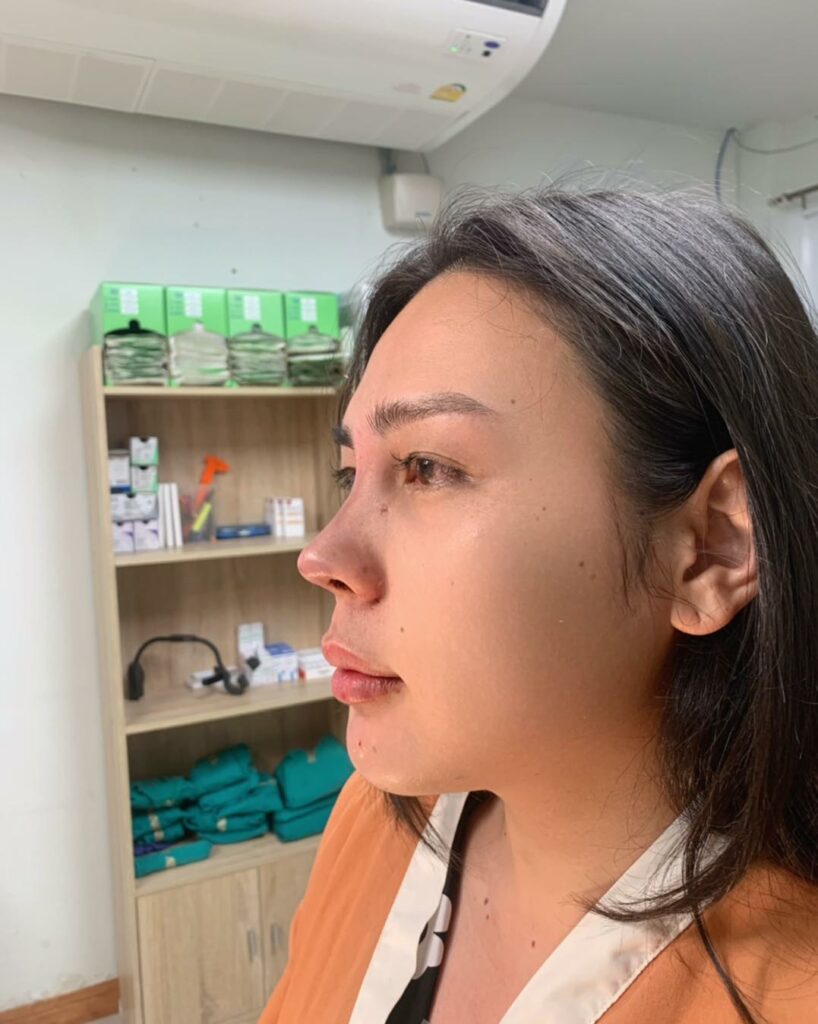 รีวิว แก้จมูก #213 , Century Clinic Thailand Century รีวิว แก้จมูก 1#213