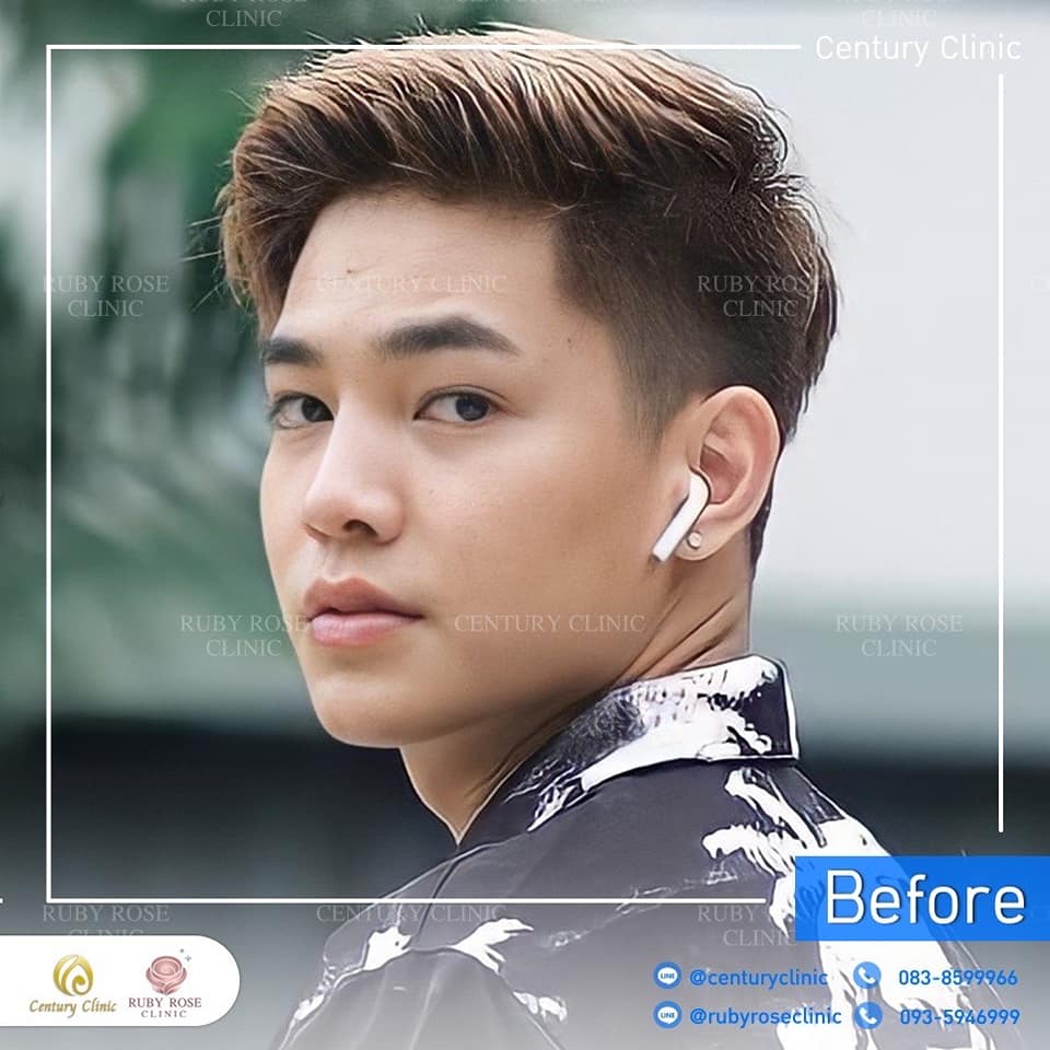 รีวิว แก้จมูก #214 , Century Clinic Thailand Century รีวิว แก้จมูก 1#214