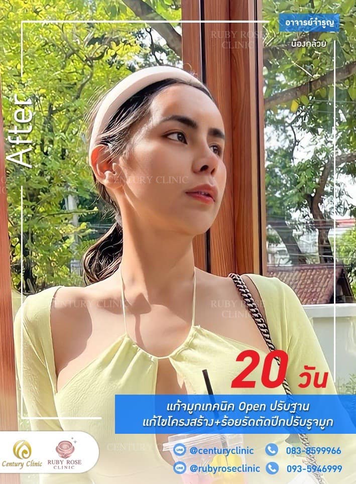 Century รีวิว แก้จมูก 1#218