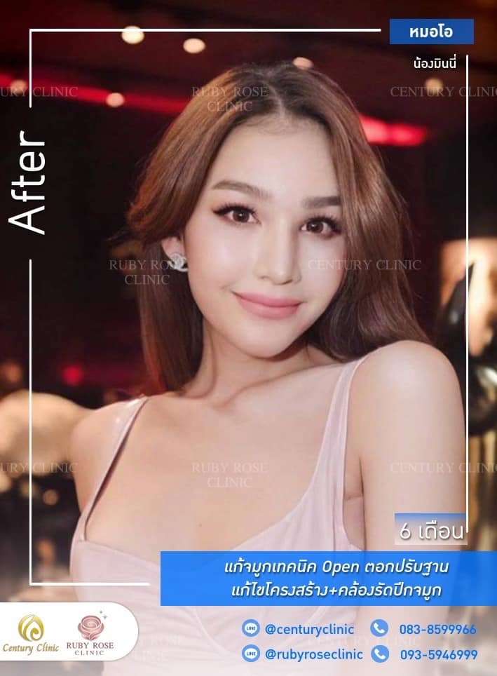 รีวิว แก้จมูก #223 , Century Clinic Thailand Century รีวิว แก้จมูก 1#223