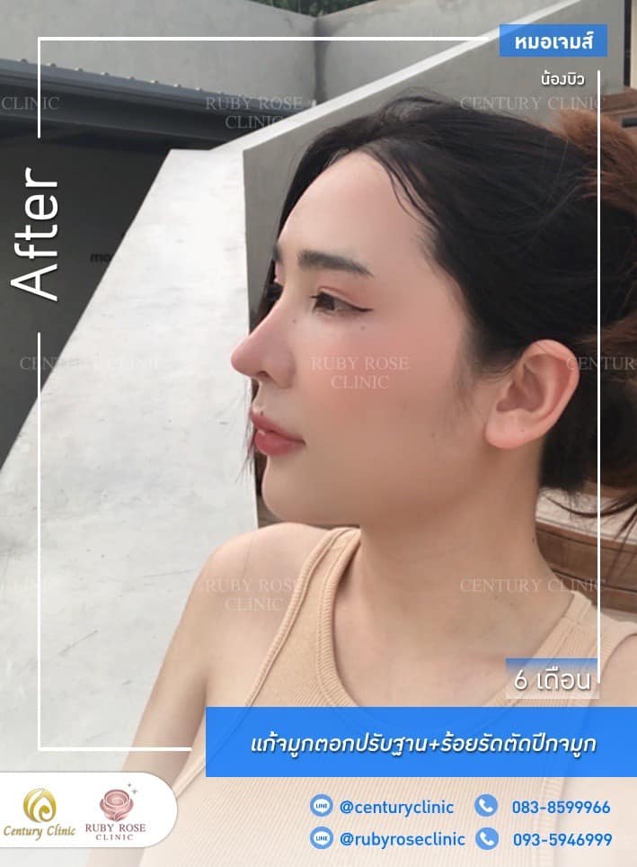 Century รีวิว แก้จมูก 1#224