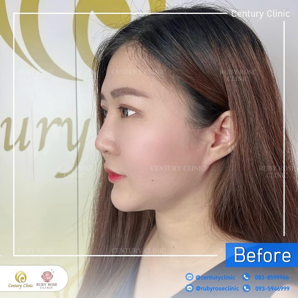 Century รีวิว แก้จมูก 1#225
