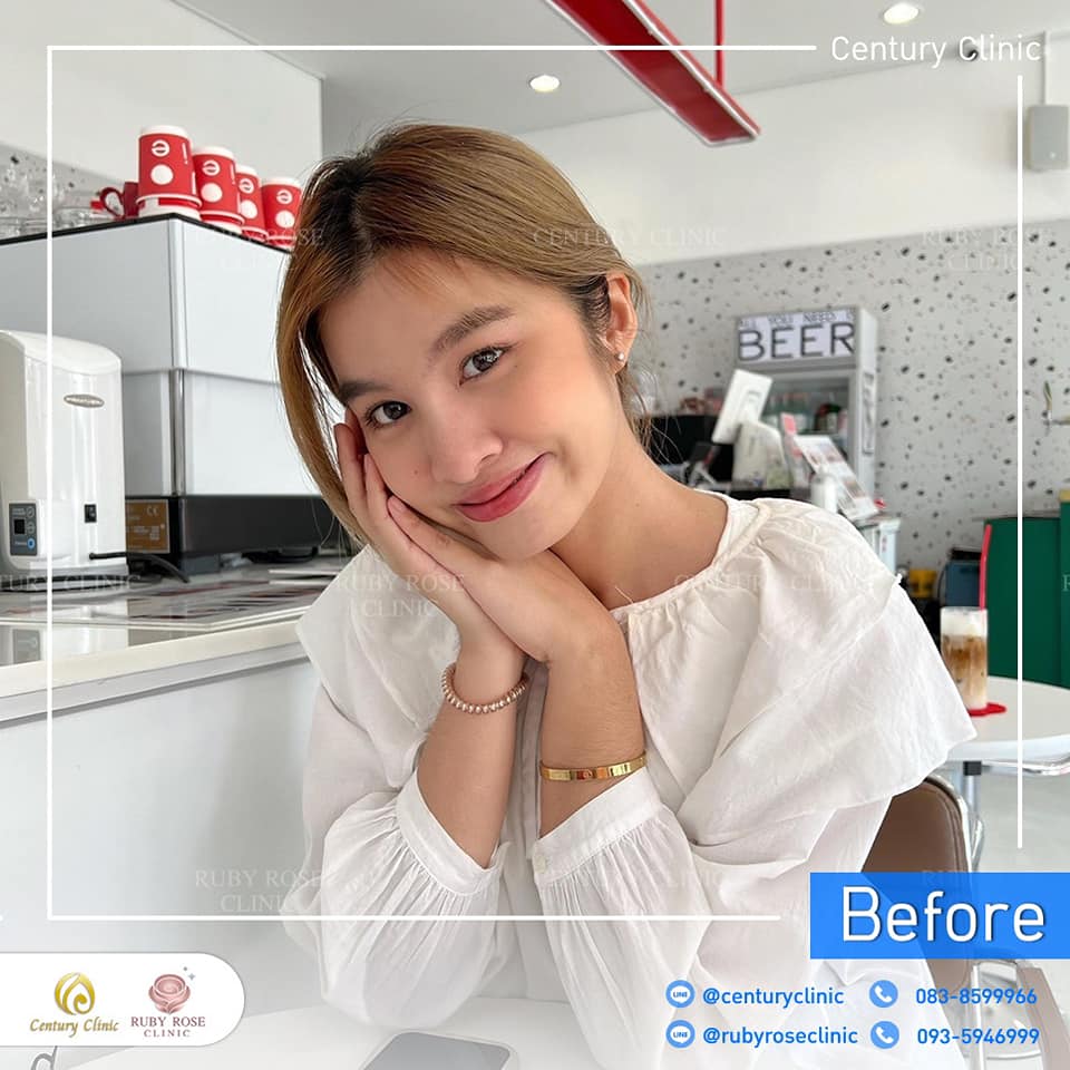 รีวิว แก้จมูก #230 , Century Clinic Thailand Century รีวิว แก้จมูก 1#230