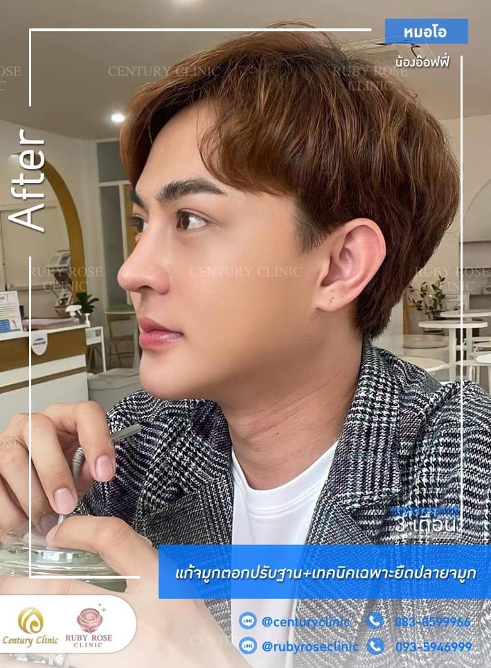 รีวิว แก้จมูก #235 , Century Clinic Thailand Century รีวิว แก้จมูก 1#235