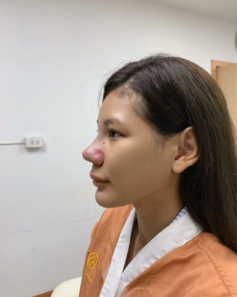 รีวิว แก้จมูก #242 , Century Clinic Thailand Century รีวิว แก้จมูก 1#241