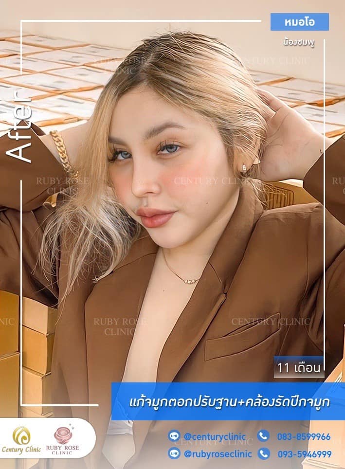 รีวิว แก้จมูก #243 , Century Clinic Thailand Century รีวิว แก้จมูก 1#242