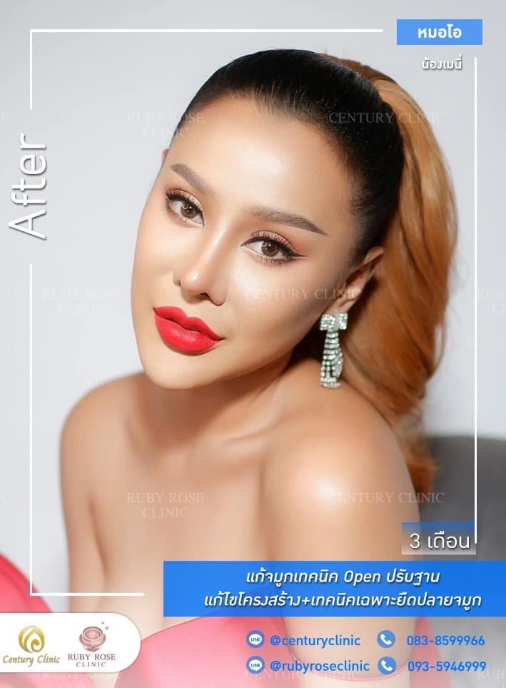 รีวิว แก้จมูก #249 , Century Clinic Thailand Century รีวิว แก้จมูก 1#249
