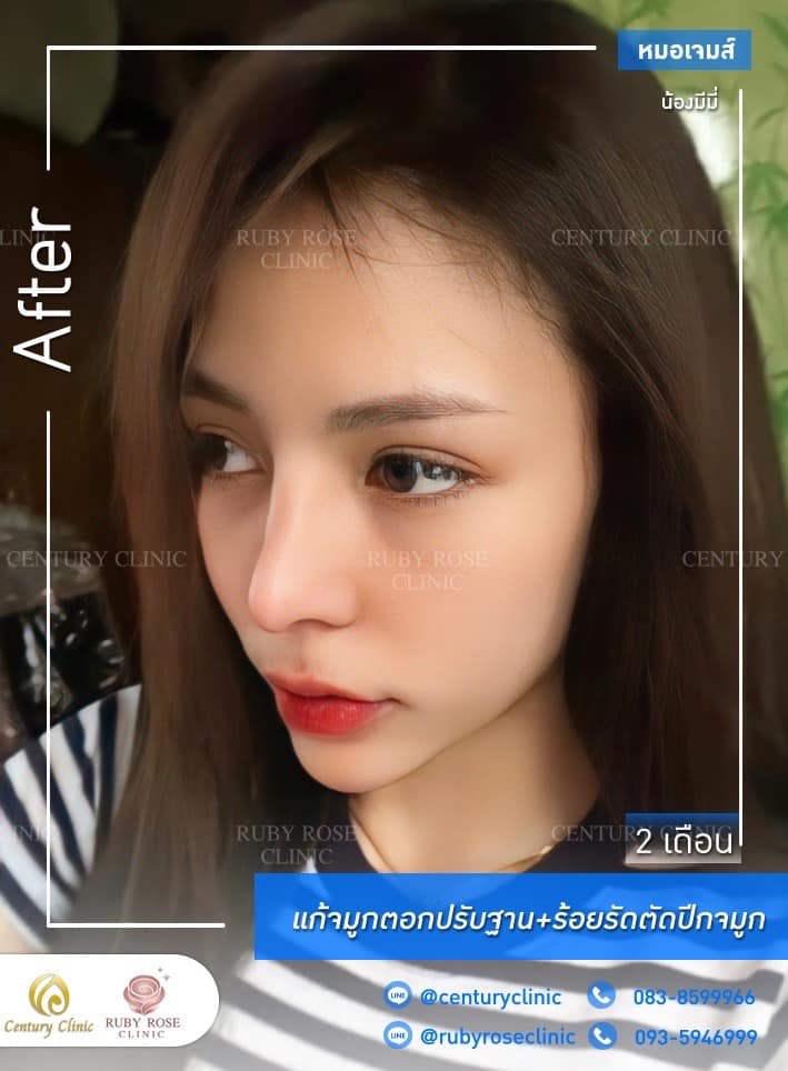 Century รีวิว แก้จมูก 1#250