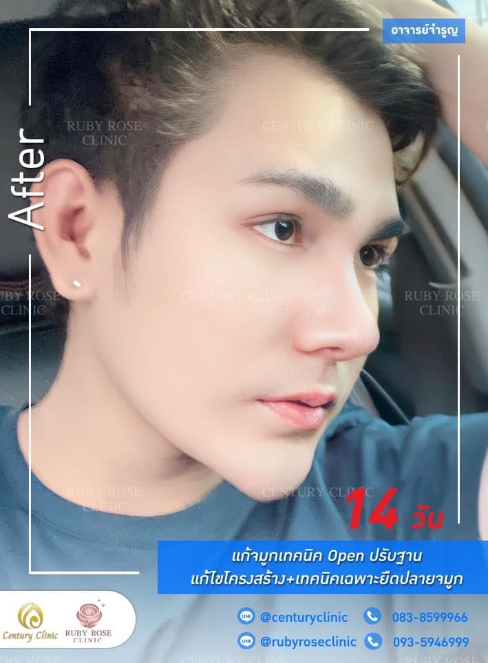 รีวิว แก้จมูก #251 , Century Clinic Thailand Century รีวิว แก้จมูก 1#251