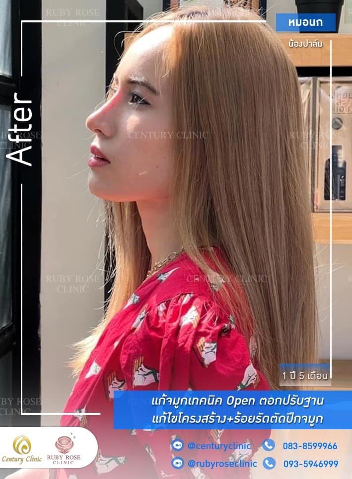 รีวิว แก้จมูก #252 , Century Clinic Thailand Century รีวิว แก้จมูก 1#252