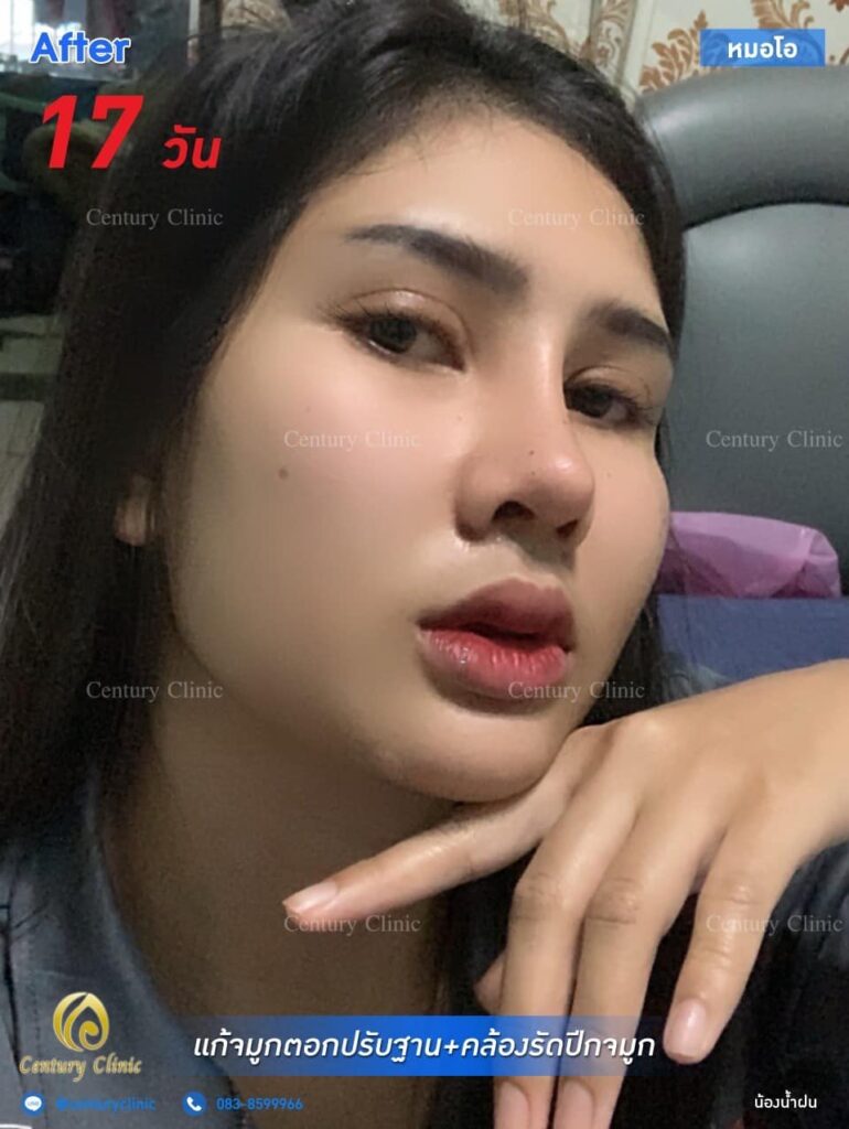 Century รีวิว แก้จมูก 1#254