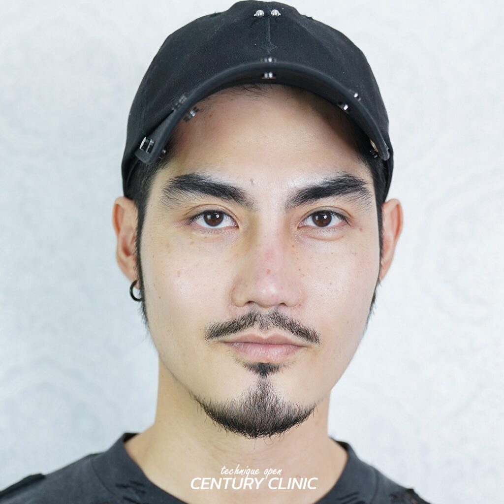 Century รีวิว แก้จมูก 1#261