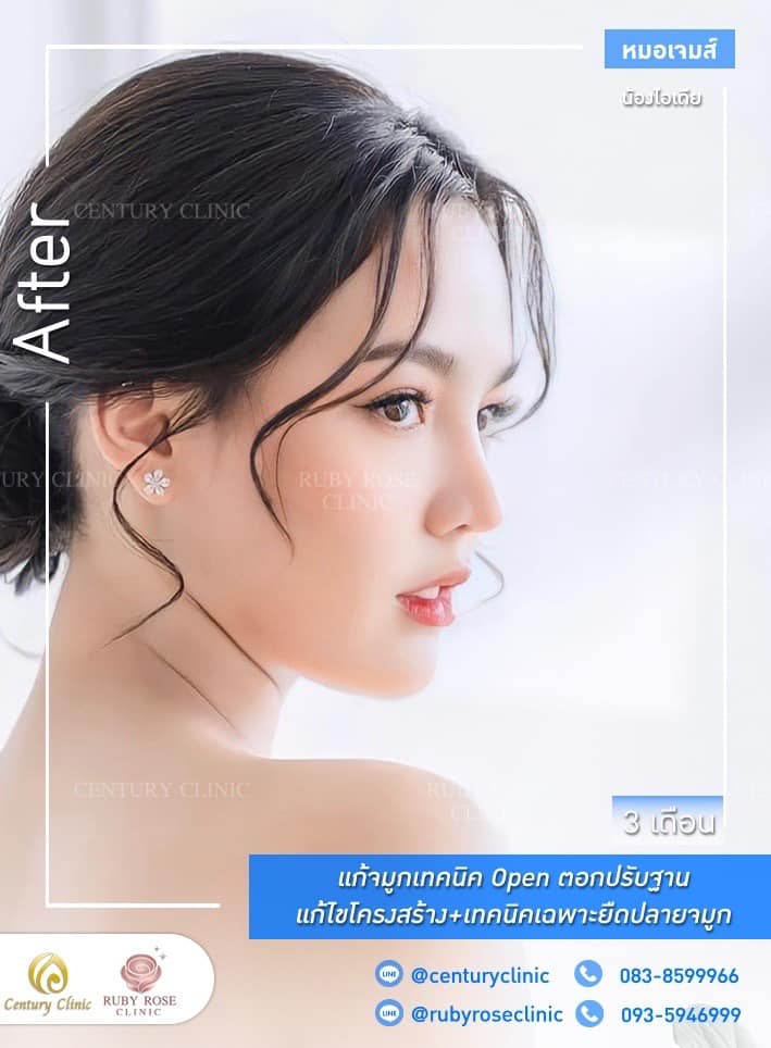 รีวิว แก้จมูก #262 , Century Clinic Thailand Century รีวิว แก้จมูก 1#262