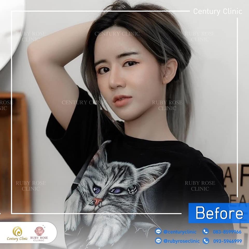 Century รีวิว แก้จมูก 1#264
