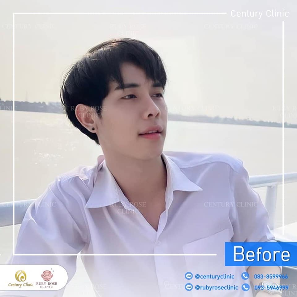 รีวิว แก้จมูก #265 , Century Clinic Thailand Century รีวิว แก้จมูก 1#265