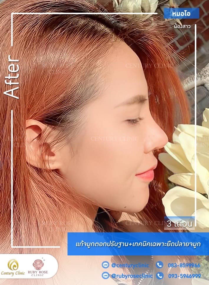 Century รีวิว แก้จมูก 1#268