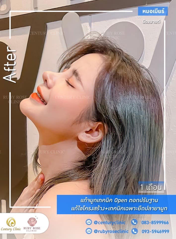 รีวิว แก้จมูก #269 , Century Clinic Thailand Century รีวิว แก้จมูก 1#269