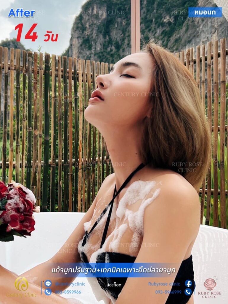 Century รีวิว แก้จมูก 1#272