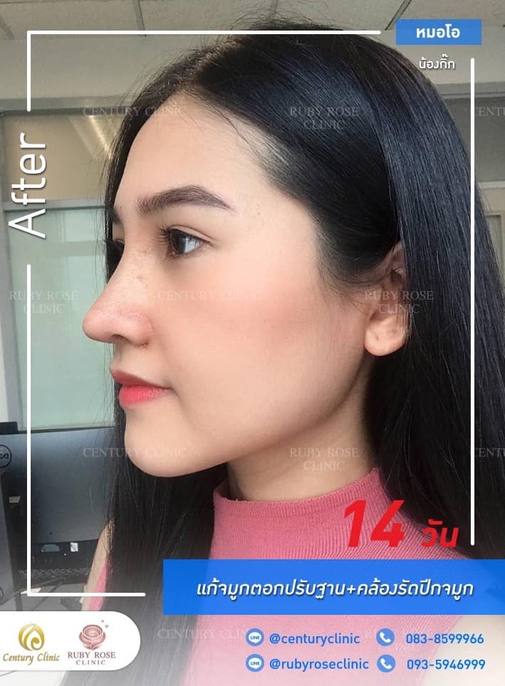 รีวิว แก้จมูก #275 , Century Clinic Thailand Century รีวิว แก้จมูก 1#275