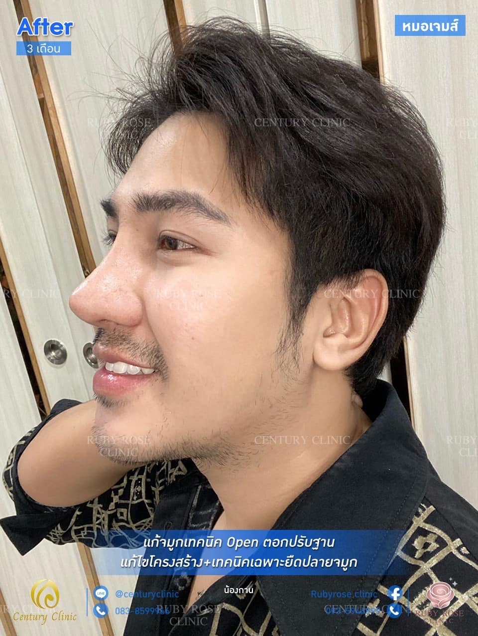 Century รีวิว แก้จมูก #156
