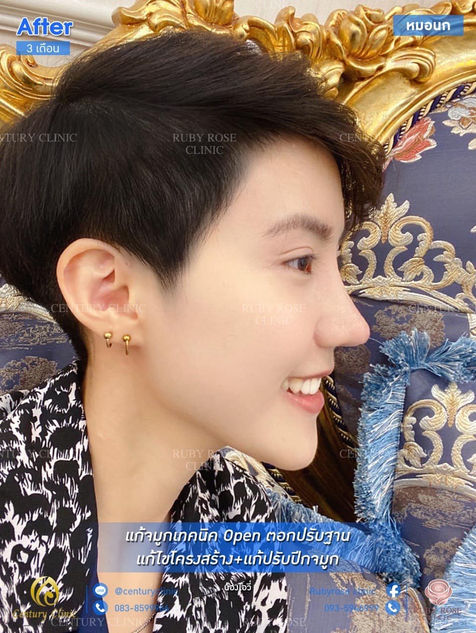 Century รีวิว แก้จมูก #158