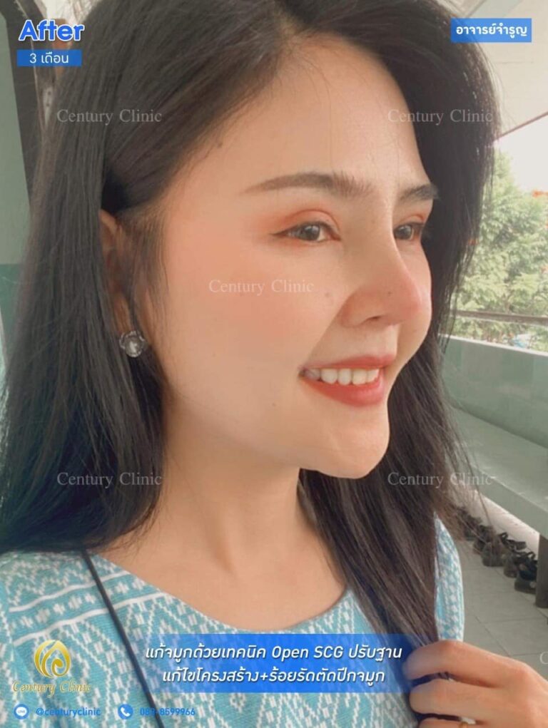 Century รีวิว แก้จมูก #159