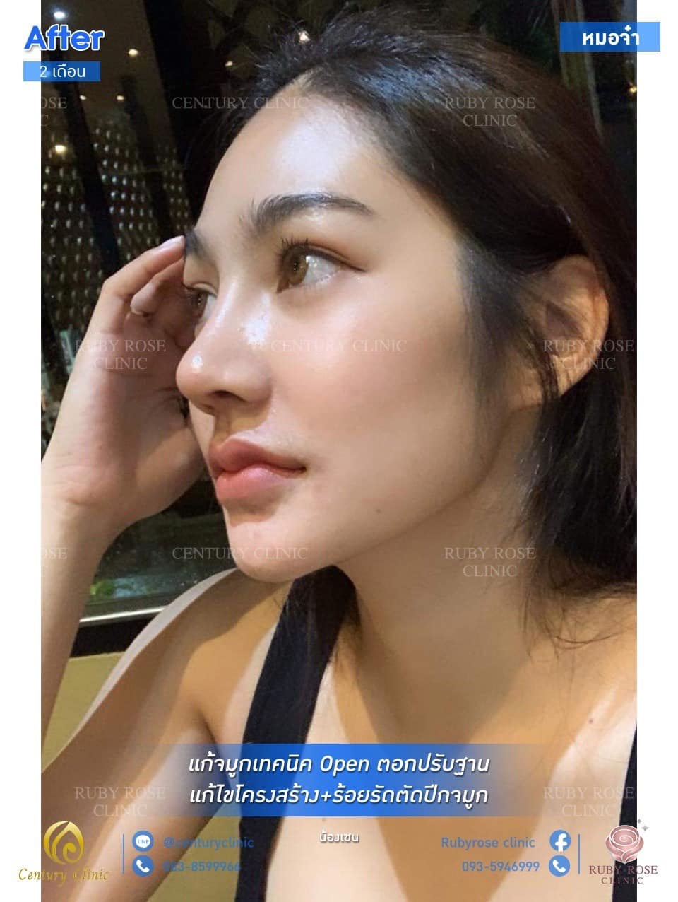 Century รีวิว แก้จมูก #161