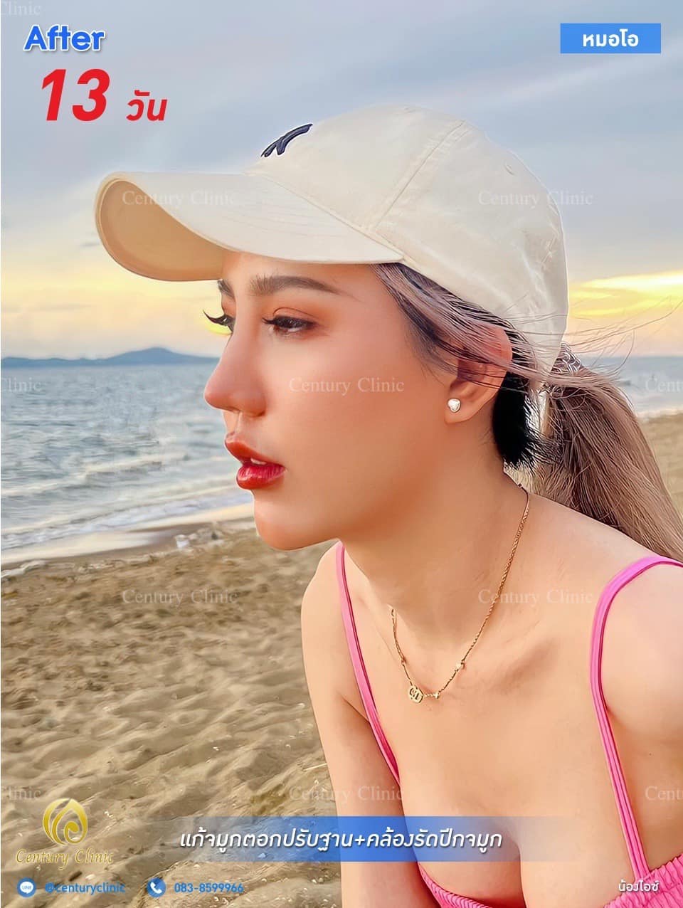 Century รีวิว แก้จมูก #165