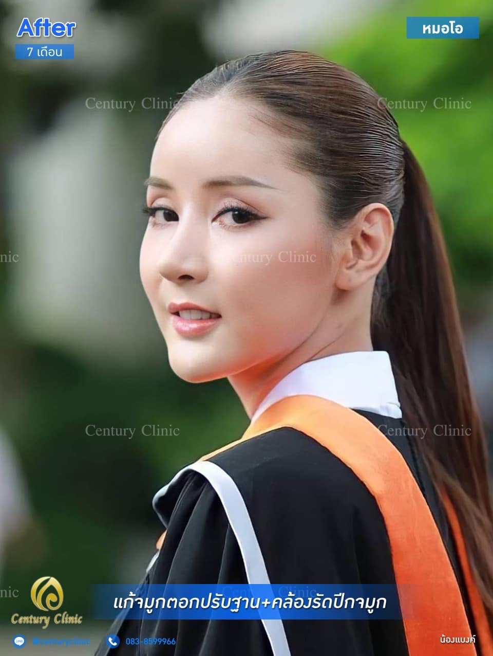 Century รีวิว แก้จมูก #168