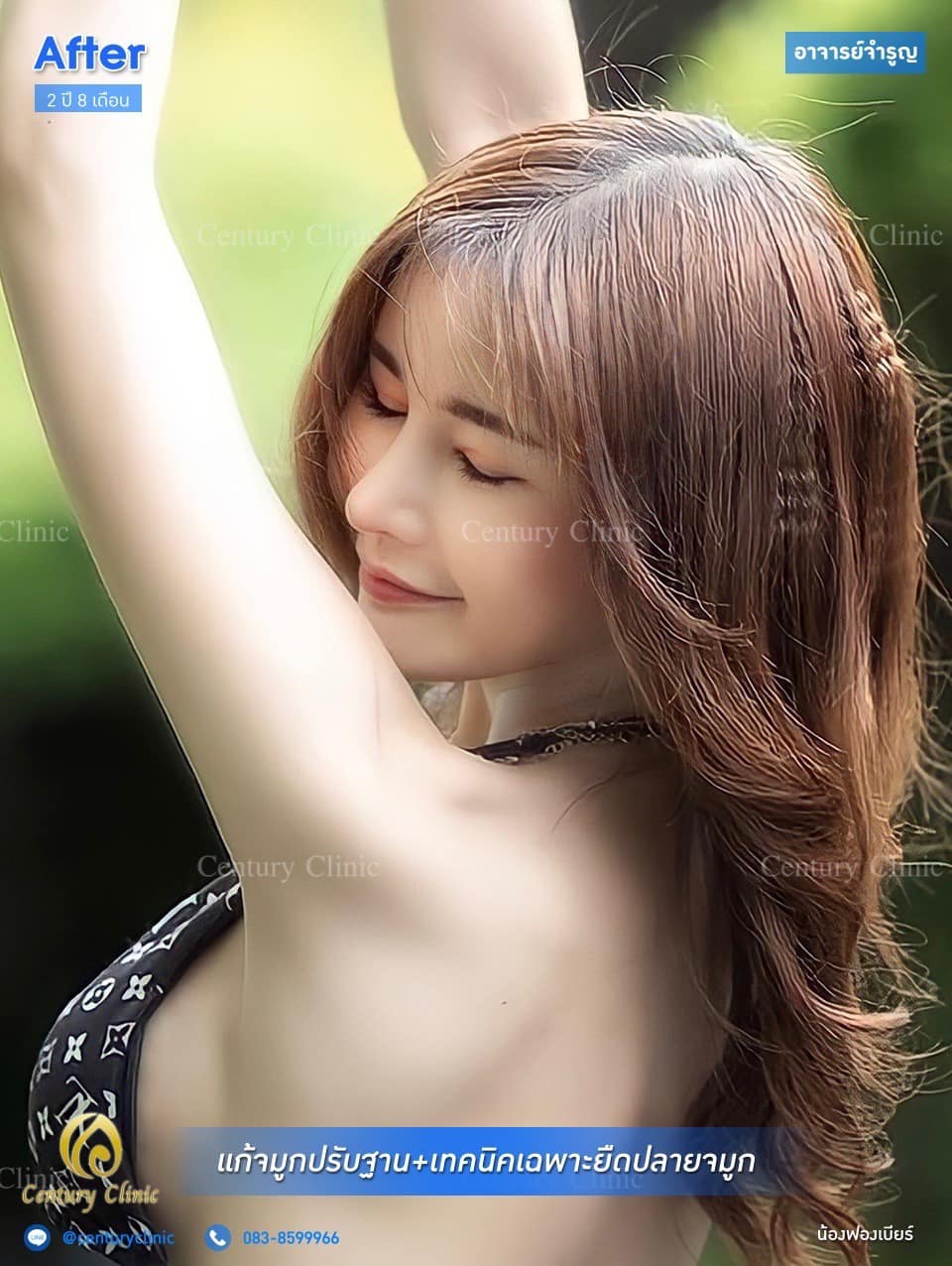 Century รีวิว แก้จมูก #169
