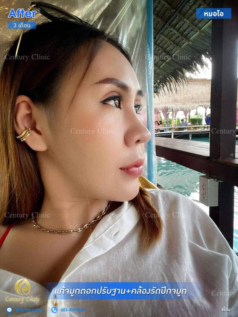 Century รีวิว แก้จมูก #171