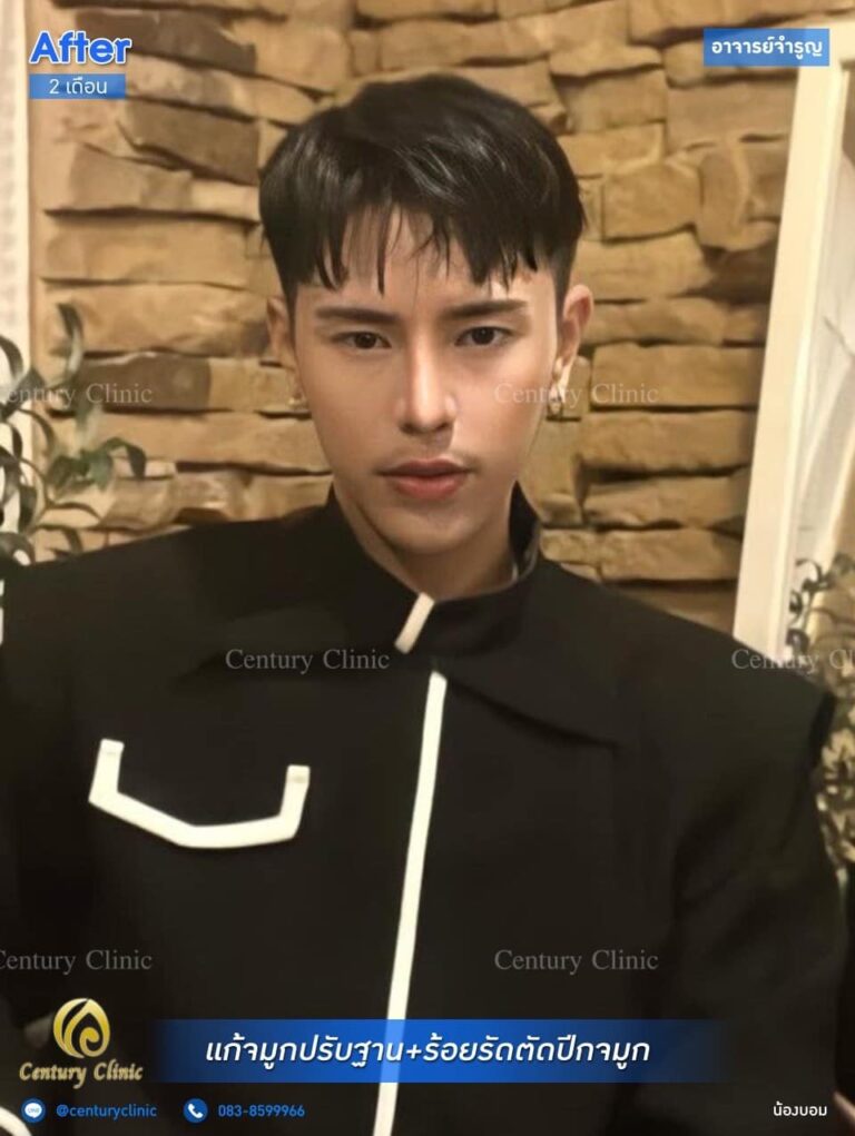 Century รีวิว แก้จมูก #181