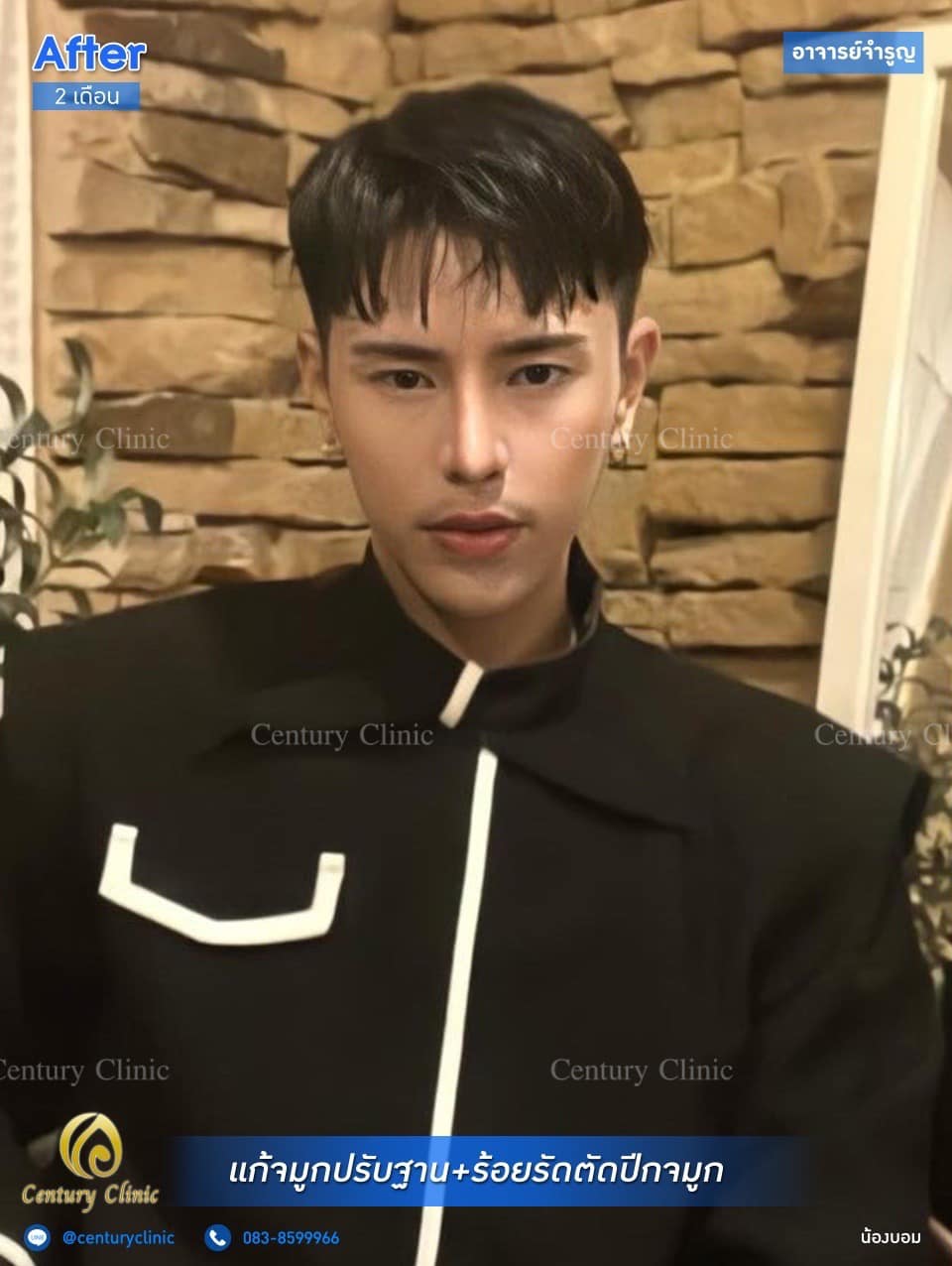 รีวิว แก้จมูก #181 , Century Clinic Thailand Century รีวิว แก้จมูก #181