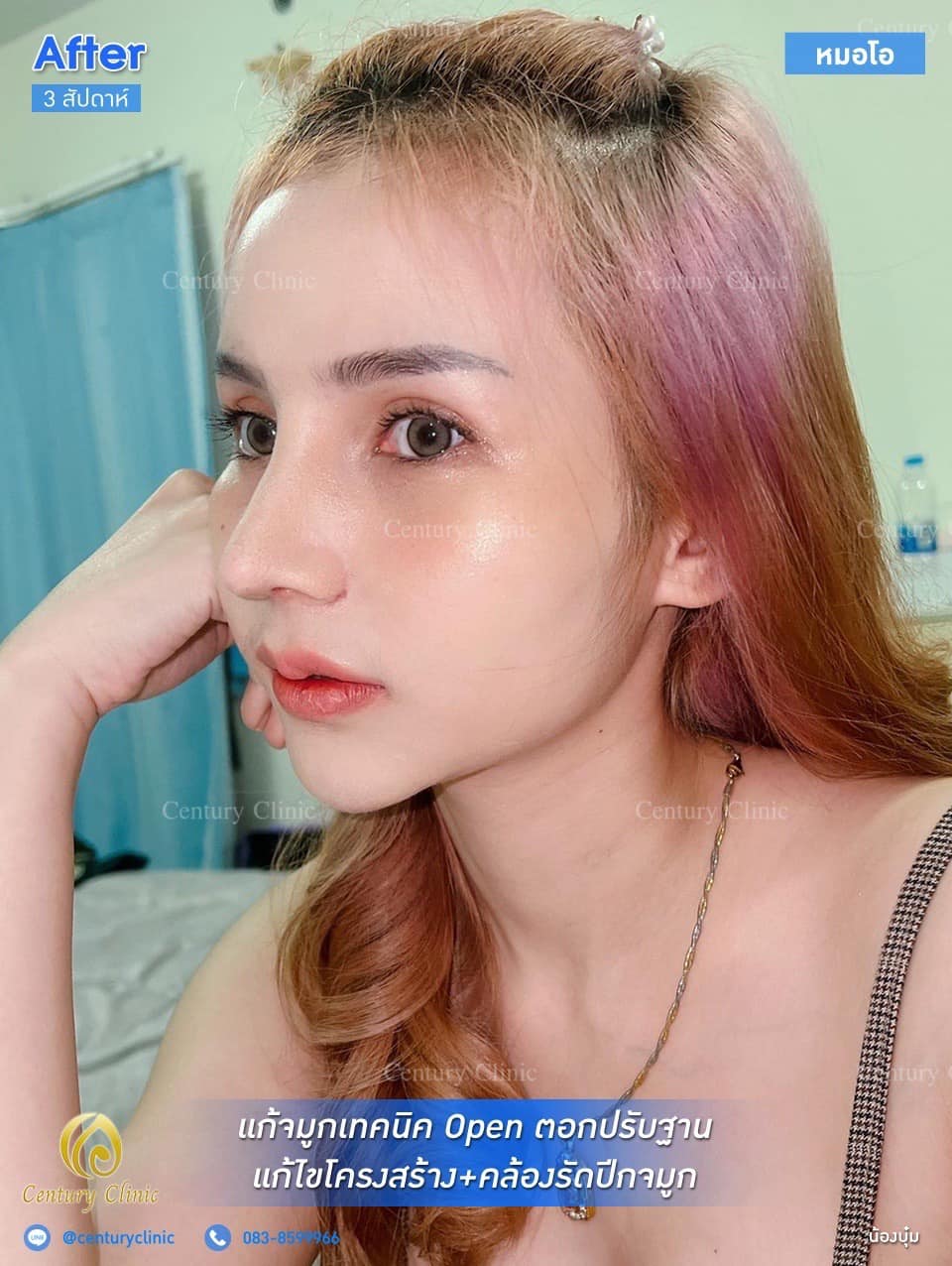 รีวิว แก้จมูก #184 , Century Clinic Thailand Century รีวิว แก้จมูก #184
