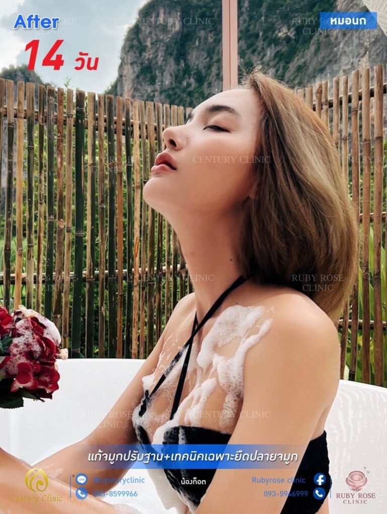Century รีวิว แก้จมูก #186