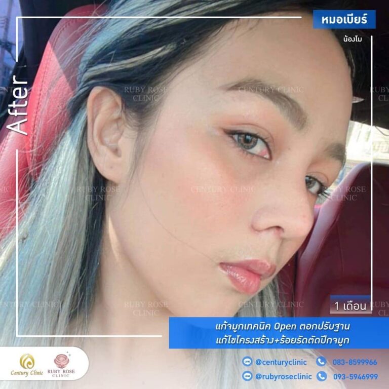 Century รีวิว แก้จมูก #191